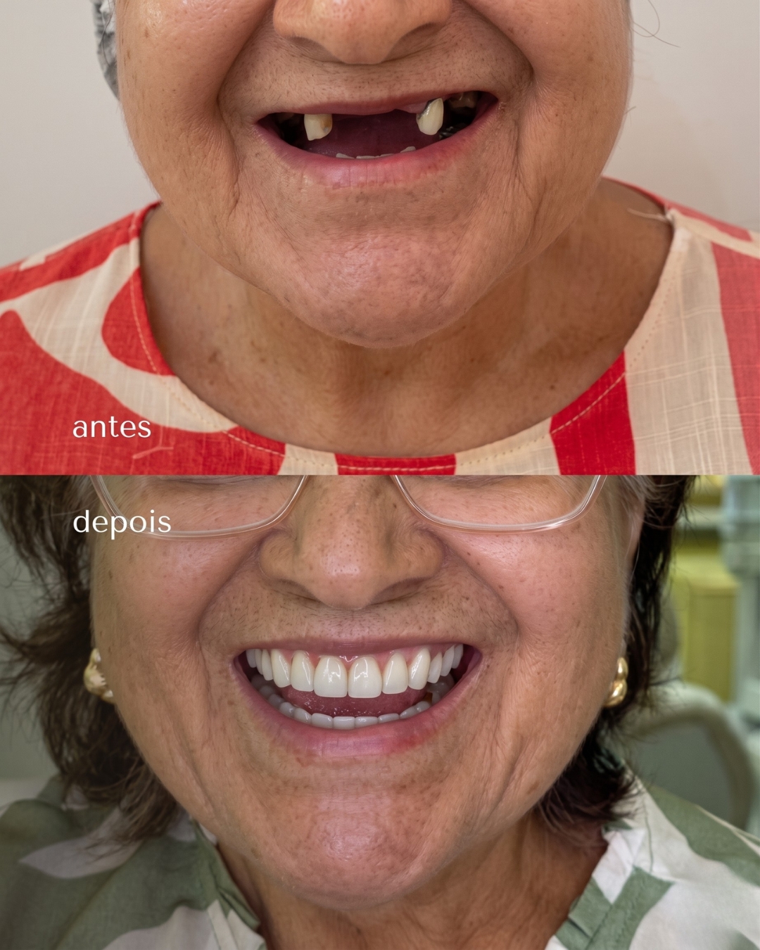 Antes e depois — implantes dentários em Solânea/PB com o Dr. Elson Fernandes